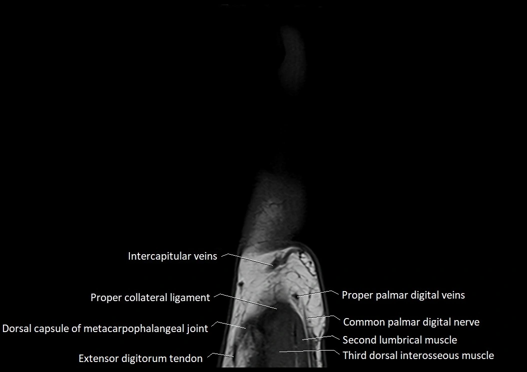 Finger anatomy sagittall cross section 3T image 10.webp